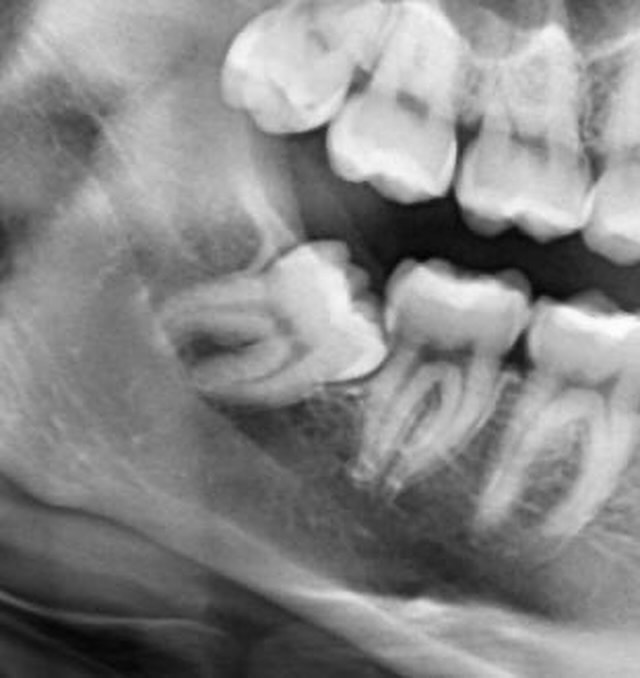 จุง - อาเชน ไอย์ดึน